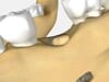Periodontal Bone Graft